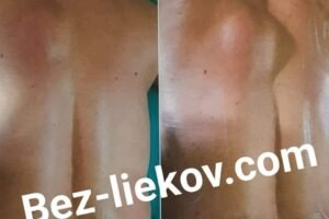 LIPÓMY – ako na podkožné tukové hrčky?