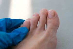 Plieseň na nechte: Konkrétne rady od lekárničky, ako sa jej zbaviť